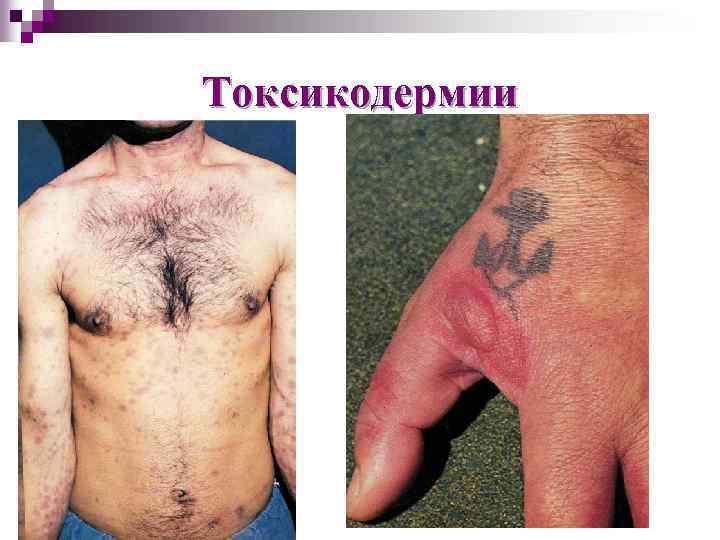 Токсикодермии 