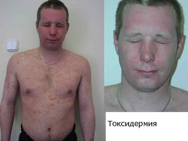 Токсидермия 