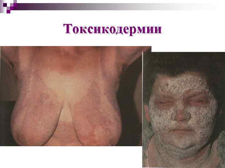 Токсикодермии 