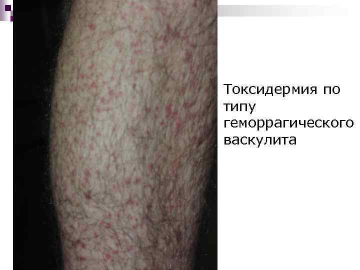 Токсидермия по типу геморрагического васкулита 