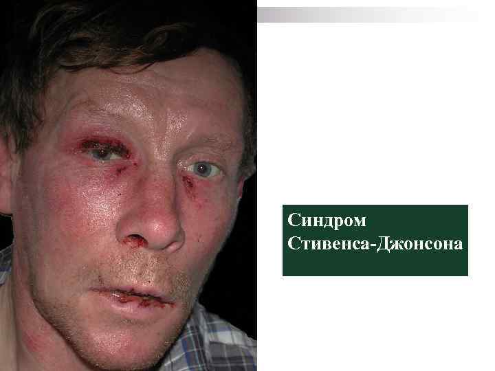 Синдром Стивенса-Джонсона 