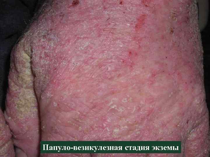 Папуло-везикулезная стадия экземы 