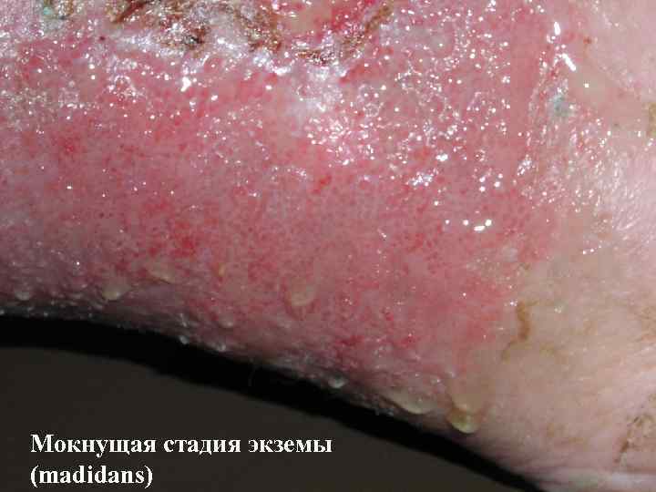 Мокнущая стадия экземы (madidans) 