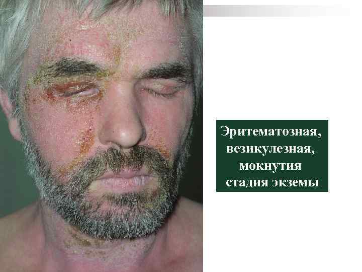 Эритематозная, везикулезная, мокнутия стадия экземы 