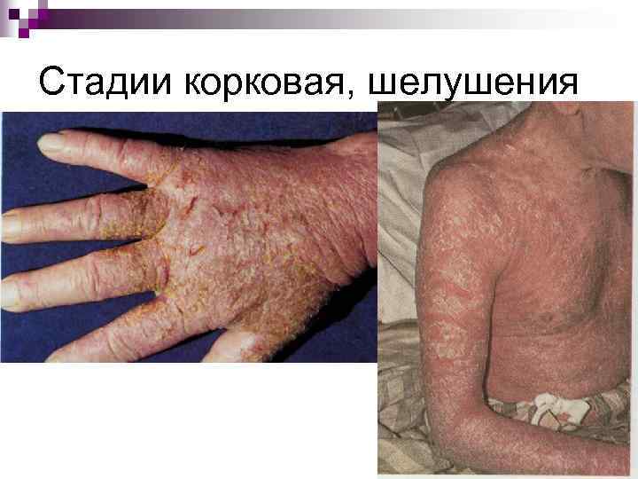 Стадии корковая, шелушения 