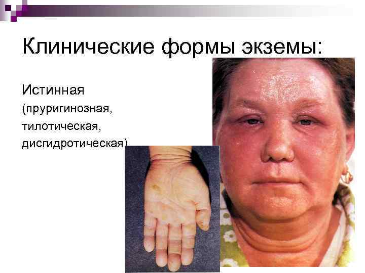 Клинические формы экземы: Истинная (пруригинозная, тилотическая, дисгидротическая) 