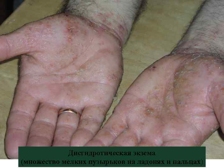 Дисгидротическая экзема (множество мелких пузырьков на ладонях и пальцах) 