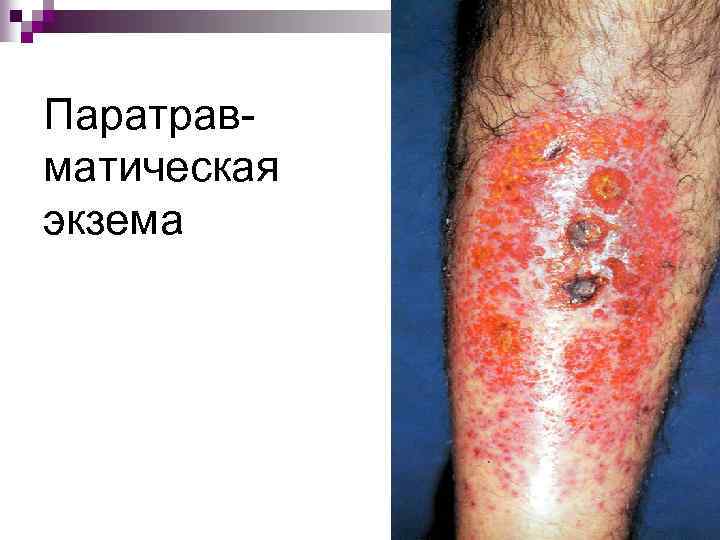 Паратравматическая экзема 