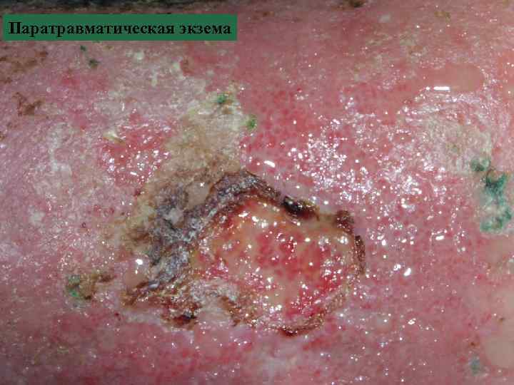 Паратравматическая экзема 