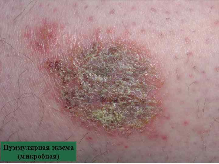 Нуммулярная экзема (микробная) 