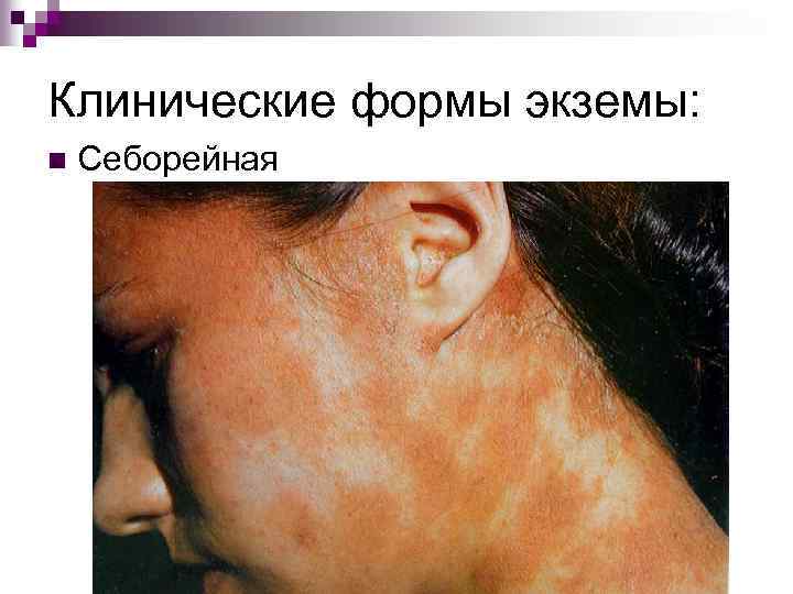Клинические формы экземы: n Себорейная 