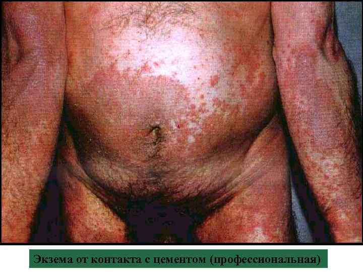 Экзема от контакта с цементом (профессиональная) 