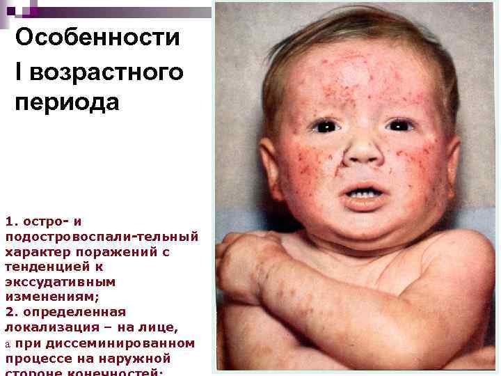 Особенности I возрастного периода 1. остро- и подостровоспали-тельный характер поражений с тенденцией к экссудативным