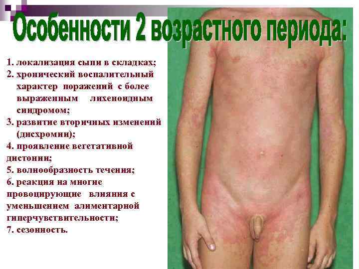 1. локализация сыпи в складках; 2. хронический воспалительный характер поражений с более выраженным лихеноидным