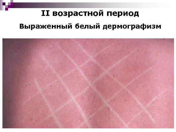 II возрастной период Выраженный белый дермографизм 