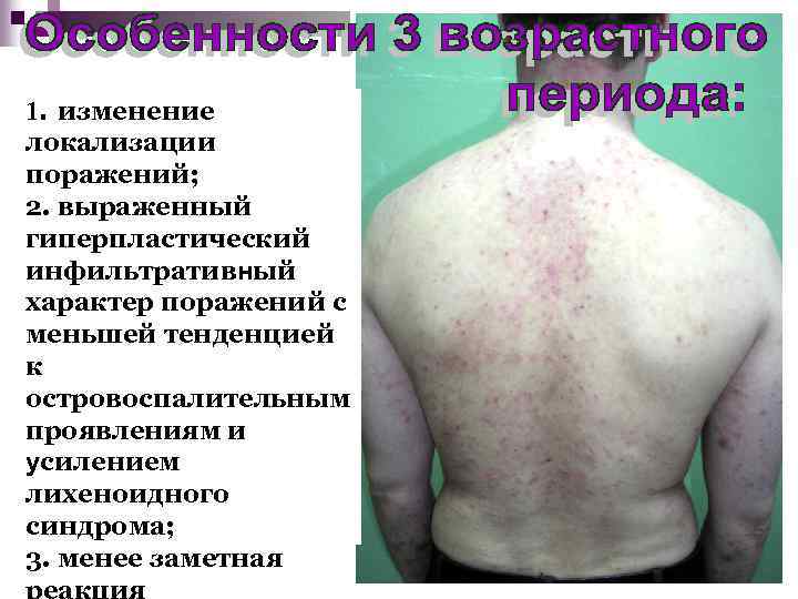 1. изменение локализации поражений; 2. выраженный гиперпластический инфильтративный характер поражений с меньшей тенденцией к
