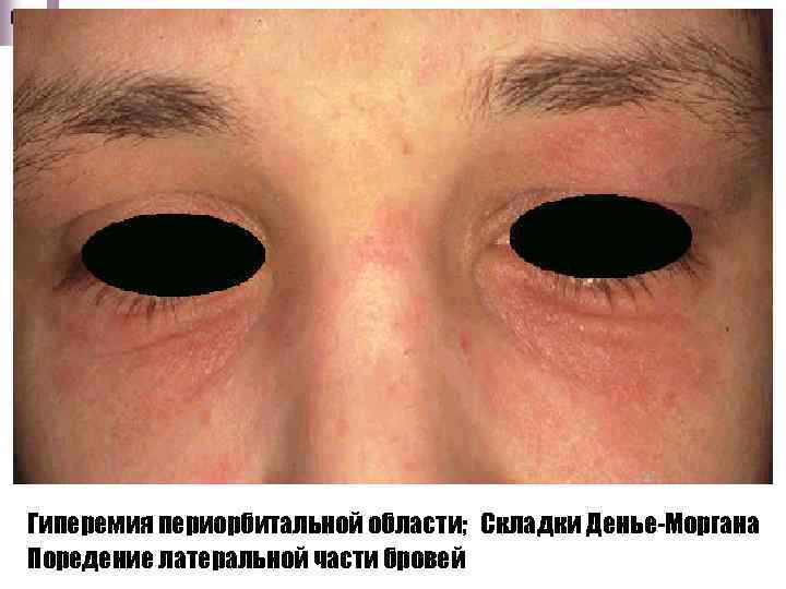Гиперемия периорбитальной области; Складки Денье-Моргана Поредение латеральной части бровей 