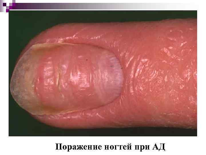 Поражение ногтей при АД 