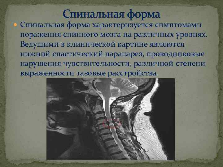 Спинальная форма характеризуется симптомами поражения спинного мозга на различных уровнях. Ведущими в клинической картине