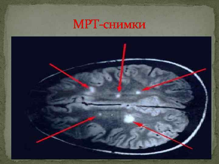 МРТ снимки 
