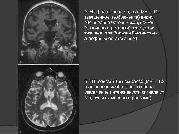 Т1 взвешенное изображение мрт