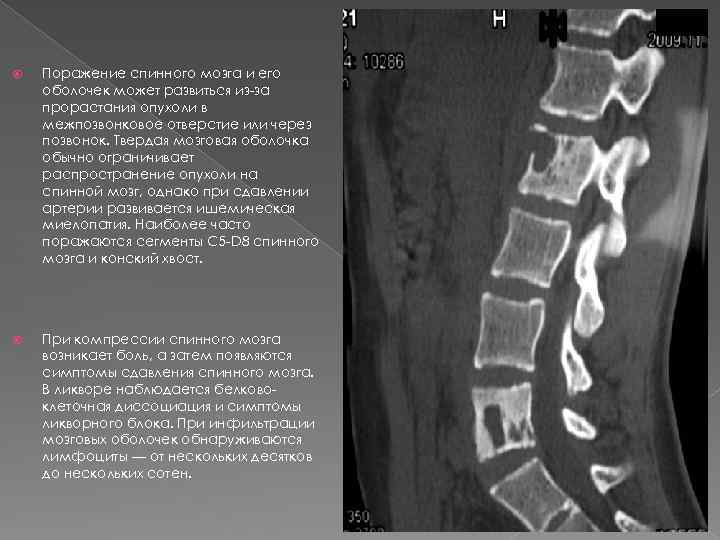 Жировая дегенерация костного мозга. Миеломная болезнь рентген позвоночника. Метастазы в тела позвонков кт. Остеолитический метастаз тела позвонка кт. Миеломная болезнь кт позвоночника описание.
