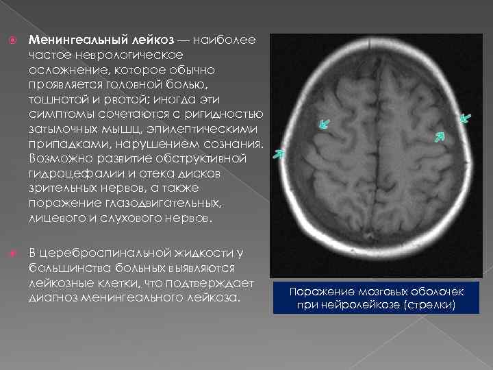 Нейролейкоз. Поражение головного мозга при лейкозе на мрт. Неврологические осложнения лейкоза. Лейкоз головной мозг мрт.