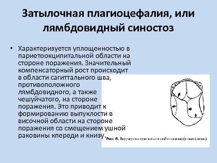 Затылочная плагиоцефалия, или лямбдовидный синостоз • Характеризуется уплощенностью в париетоокципитальной области на стороне поражения.