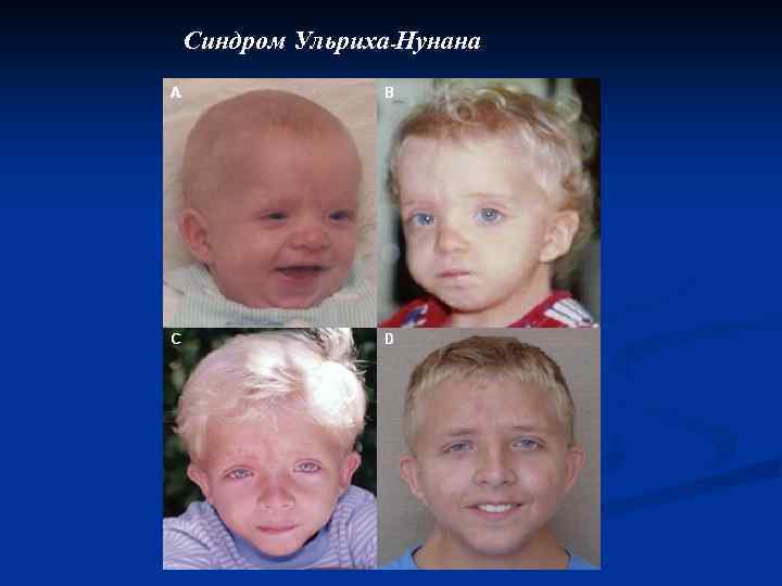 Синдром Ульриха-Нунана 