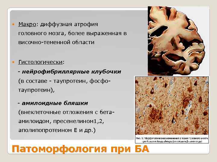  Макро: диффузная атрофия головного мозга, более выраженная в височно-теменной области Гистологически: - нейрофибриллярные