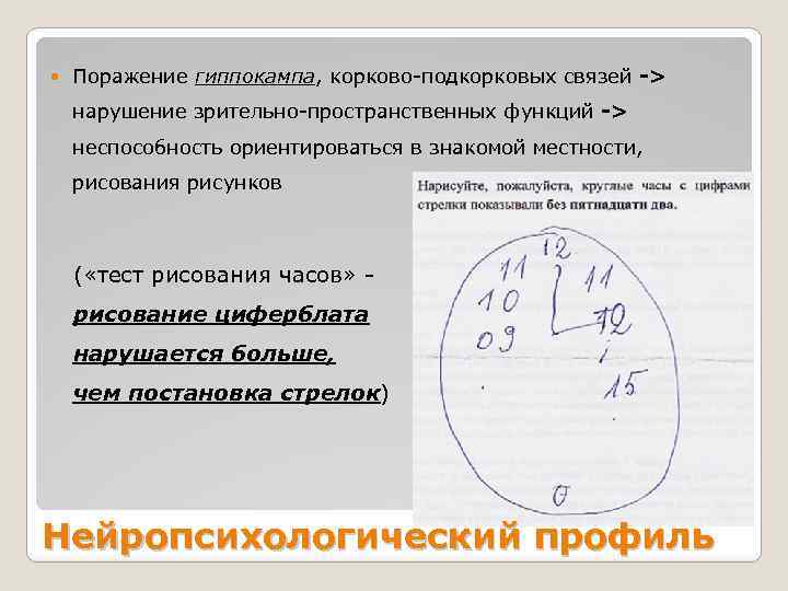  Поражение гиппокампа, корково-подкорковых связей -> нарушение зрительно-пространственных функций -> неспособность ориентироваться в знакомой