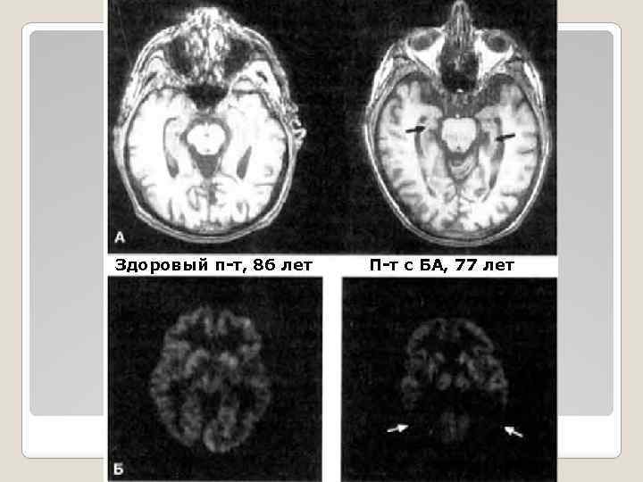 Здоровый п-т, 86 лет П-т с БА, 77 лет 