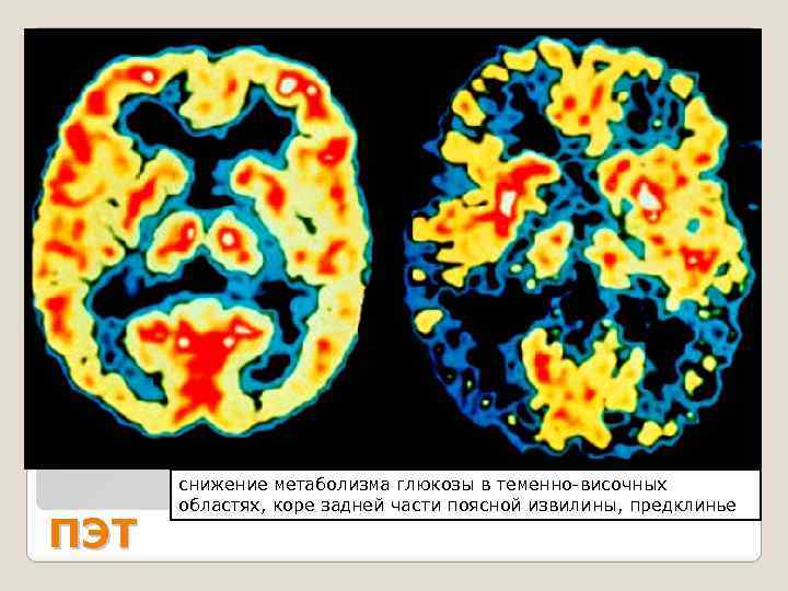 ПЭТ снижение метаболизма глюкозы в теменно-височных областях, коре задней части поясной извилины, предклинье 