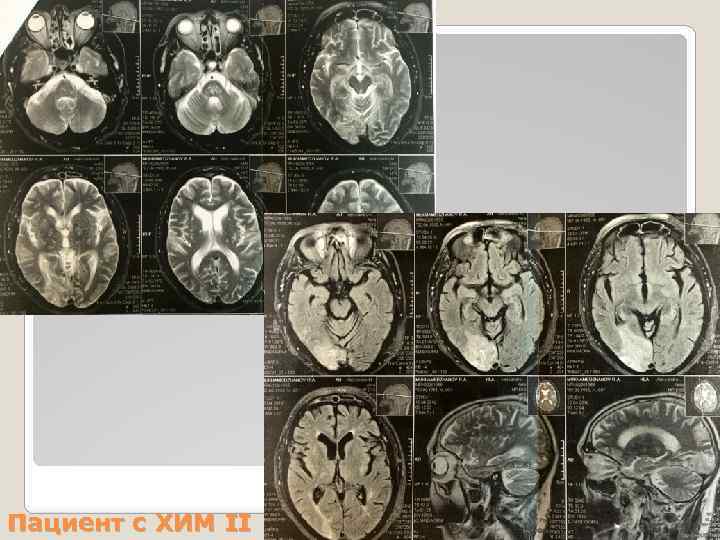 Пациент с ХИМ II 