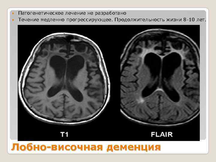 Патогенетическое лечение не разработано Течение медленно прогрессирующее. Продолжительность жизни 8 -10 лет. Лобно-височная деменция
