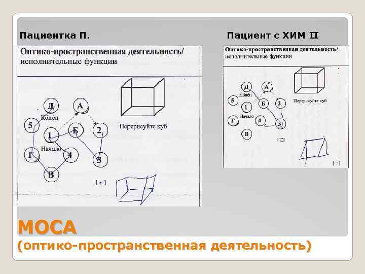 Пациентка П. МОСА Пациент с ХИМ II (оптико-пространственная деятельность) 