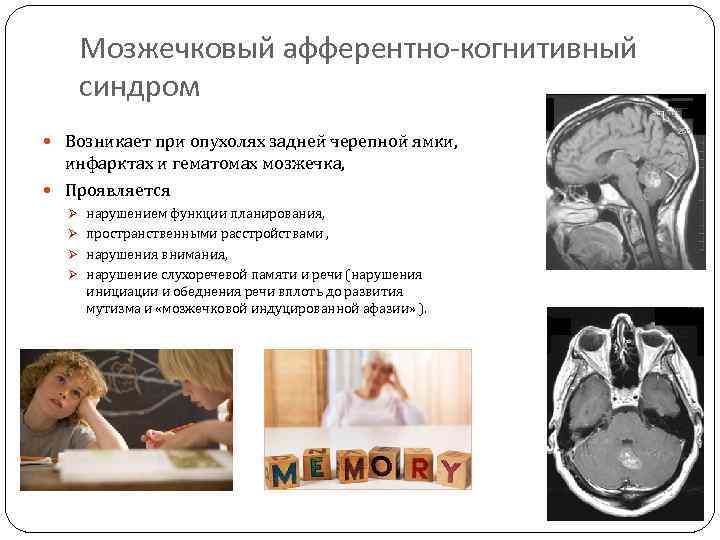Мозжечковый афферентно-когнитивный синдром Возникает при опухолях задней черепной ямки, инфарктах и гематомах мозжечка, Проявляется