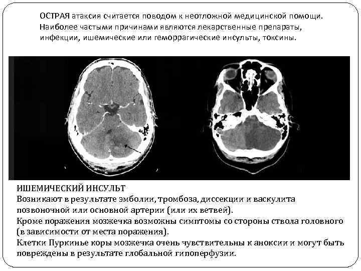 ОСТРАЯ атаксия считается поводом к неотложной медицинской помощи. Наиболее частыми причинами являются лекарственные препараты,