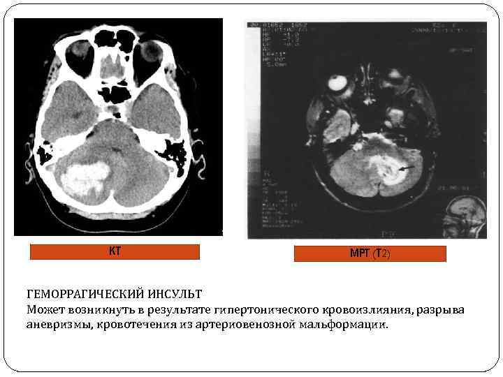 КТ МРТ (Т 2) ГЕМОРРАГИЧЕСКИЙ ИНСУЛЬТ Может возникнуть в результате гипертонического кровоизлияния, разрыва аневризмы,