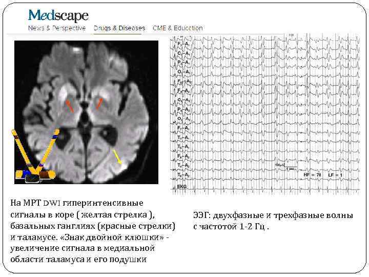 На МРТ DWI гиперинтенсивные сигналы в коре ( желтая стрелка ), базальных ганглиях (красные