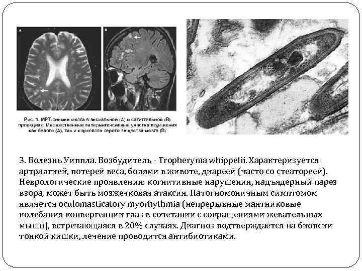 Болезнь уиппла презентация