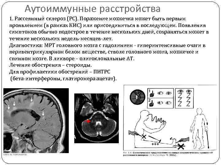 Аутоиммунные расстройства 1. Рассеянный склероз (РС). Поражение мозжечка может быть первым проявлением (в рамках