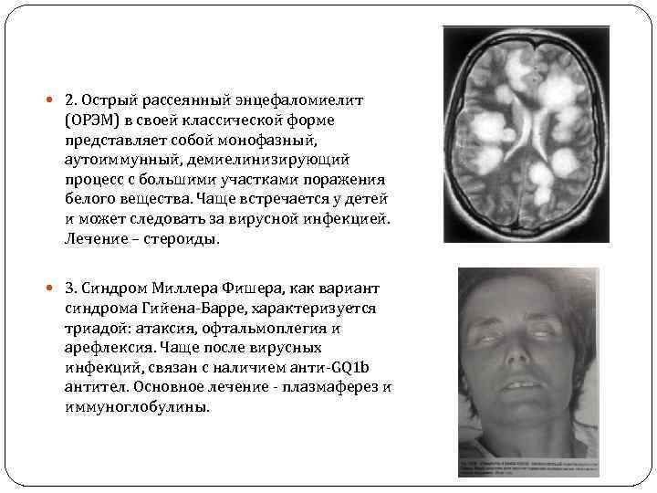  2. Острый рассеянный энцефаломиелит (ОРЭМ) в своей классической форме представляет собой монофазный, аутоиммунный,