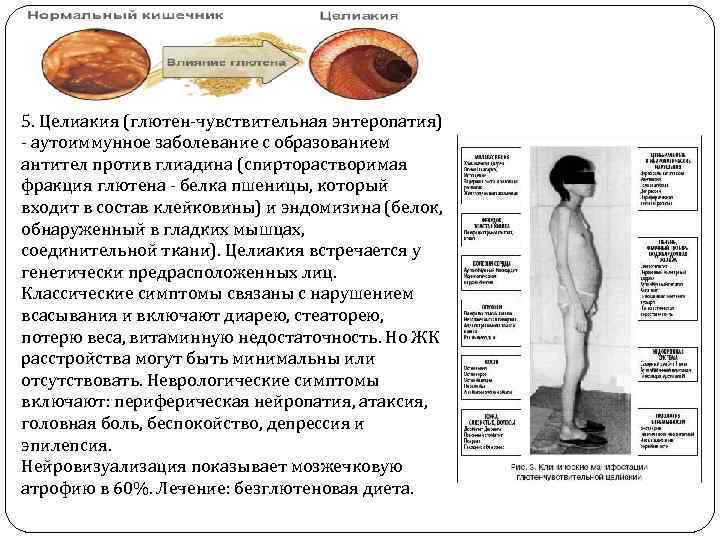 5. Целиакия (глютен-чувствительная энтеропатия) - аутоиммунное заболевание с образованием антител против глиадина (спирторастворимая фракция