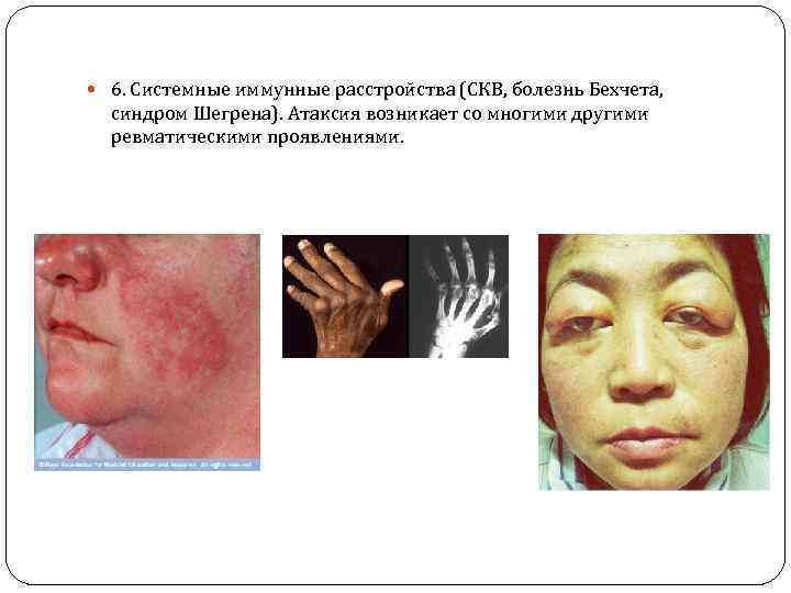  6. Системные иммунные расстройства (СКВ, болезнь Бехчета, синдром Шегрена). Атаксия возникает со многими