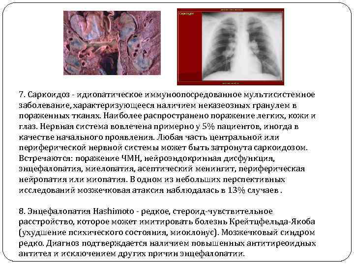 7. Саркоидоз - идиопатическое иммуноопосредованное мультисистемное заболевание, характеризующееся наличием неказеозных гранулем в пораженных тканях.