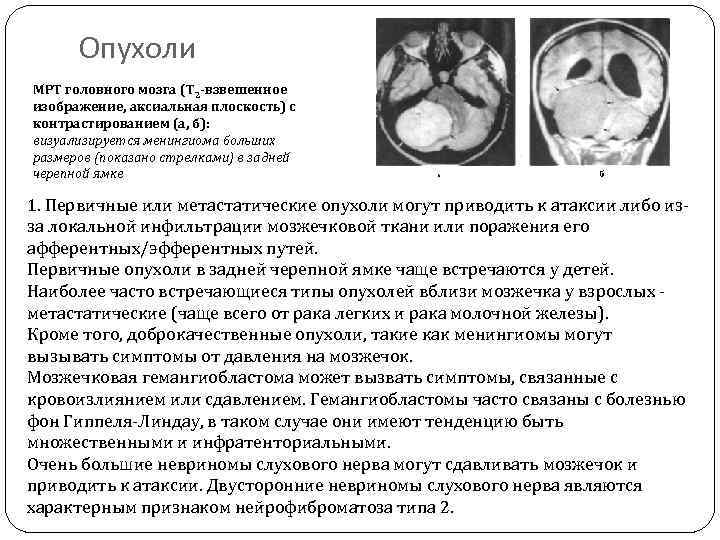Опухоли МРТ головного мозга (Т 2 -взвешенное изображение, аксиальная плоскость) с контрастированием (а, б):