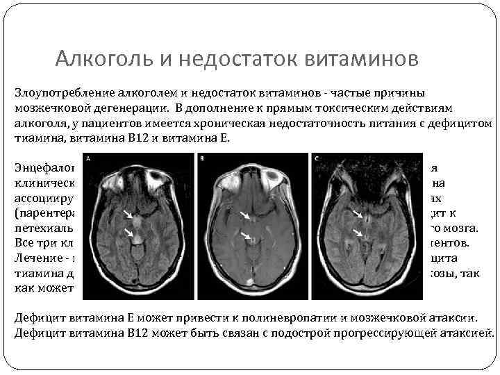 Алкоголь и недостаток витаминов Злоупотребление алкоголем и недостаток витаминов - частые причины мозжечковой дегенерации.