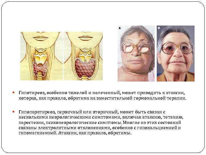  Гипотиреоз, особенно тяжелой и нелеченный, может приводить к атаксии, которая, как правило, обратима