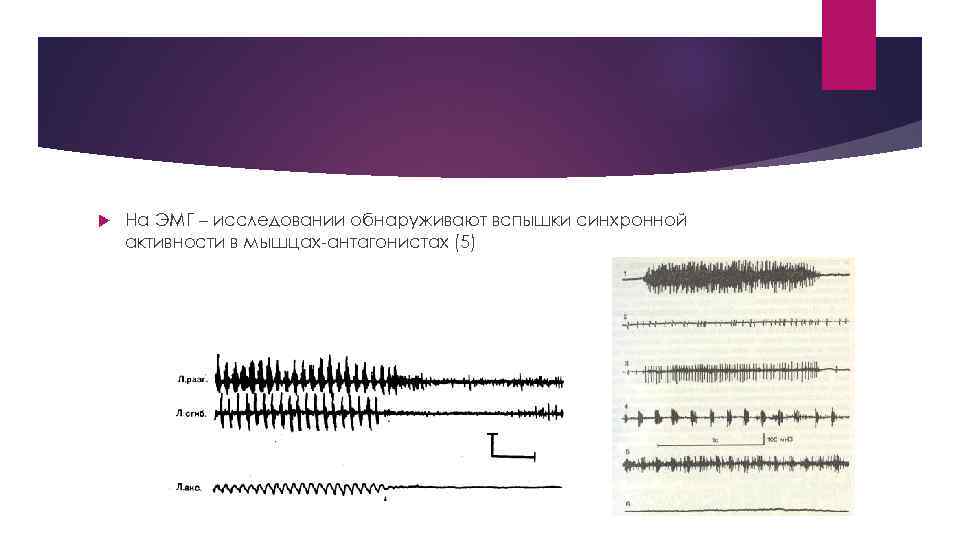 Эмг самара. Эссенциальный тремор диагноз.